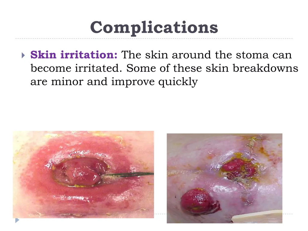wound 4