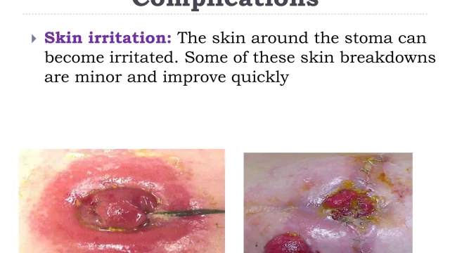 wound 4